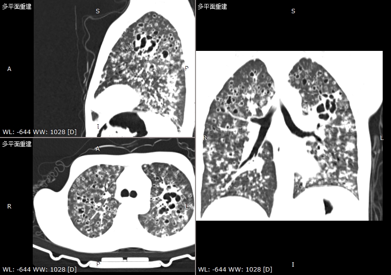 3D_MPR_-_ZHUANG_BAO_XIANG‎_(32y)_-_2024_9_22_13_15_40_-_胸部_1.50_Br40_S3_0000.jpg